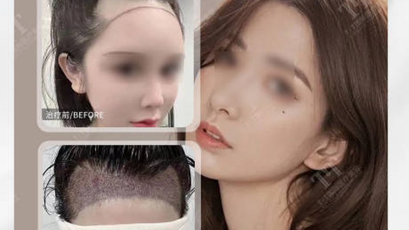 美容院超声炮：安装调试那些事，揭秘行业“黑科技