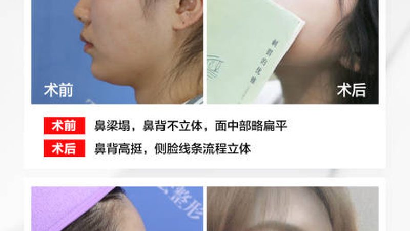 激光祛斑仪器：揭秘批发报价背后的参数奥秘