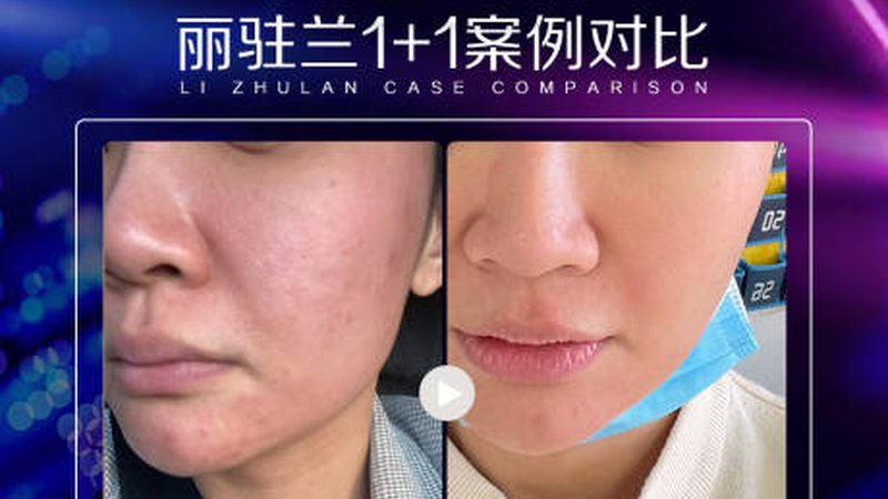 国产与进口瘦脸针：价格差异背后的真相