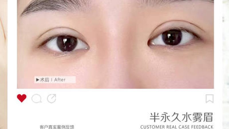 玻尿酸与自体脂肪填充：面部年轻化的两种选择