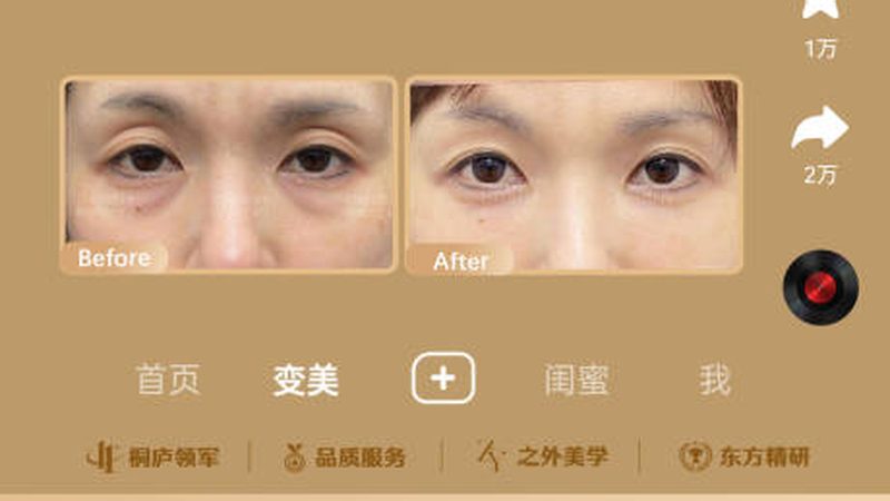 热玛吉手术，医生操作标准揭秘