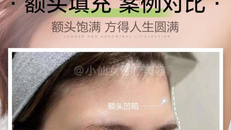 小标题：激光脱毛原理及分类